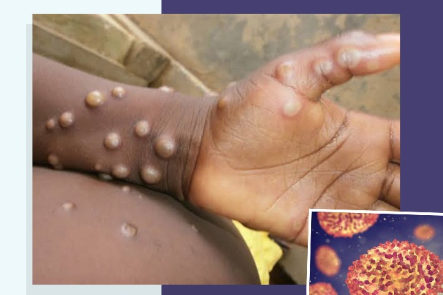 TS government on alert on monkeypox