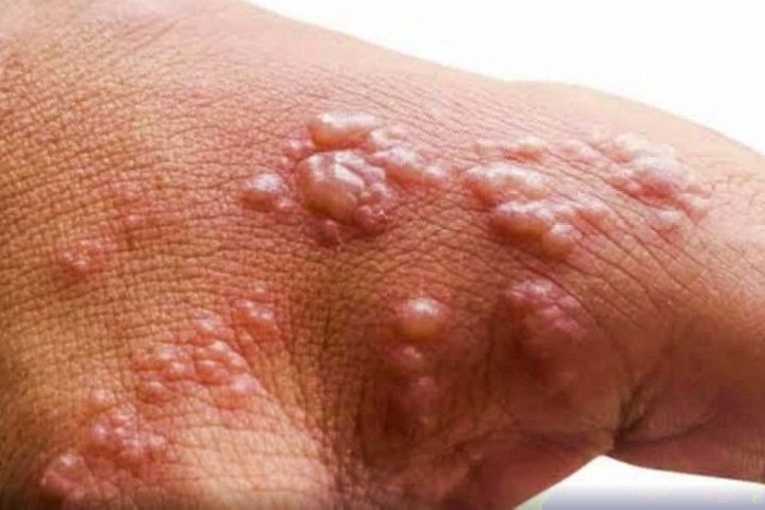 Suspected monkeypox patient in Andhra tests negative