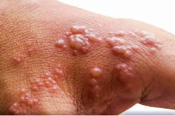 Delhi's 1st monkeypox patient recovers, discharged from hospital