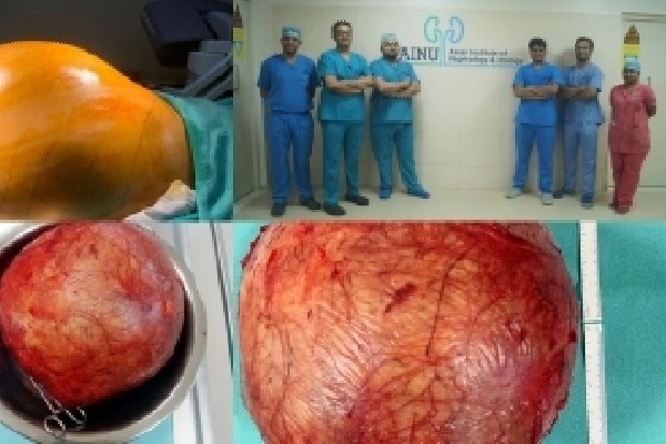Doctors at Hyderabad hospital remove football-sized kidney tumour
