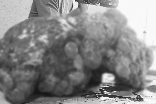 Doctors at Hyderabad hospital remove 12 kg liver from woman