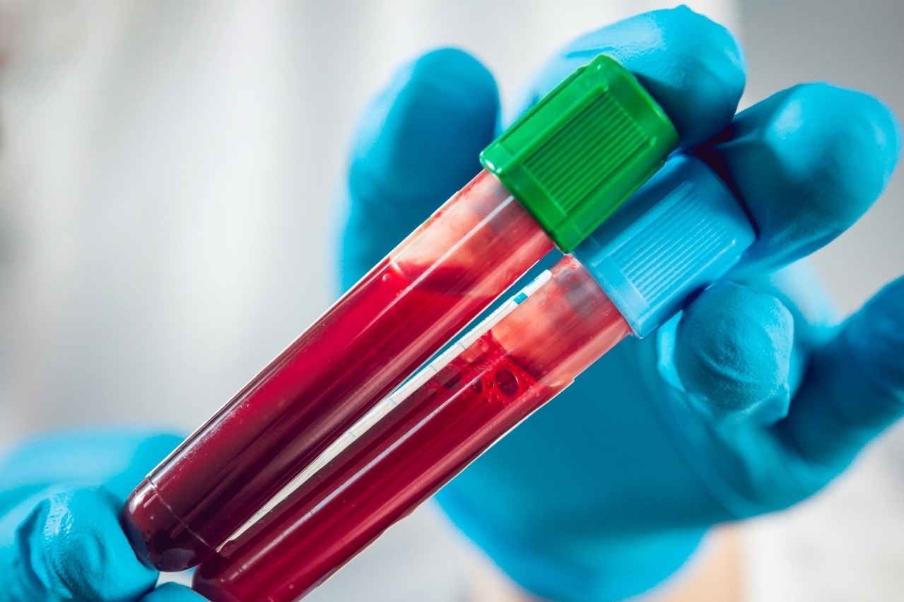 New blood test may detect ovarian cancer early with 91% accuracy