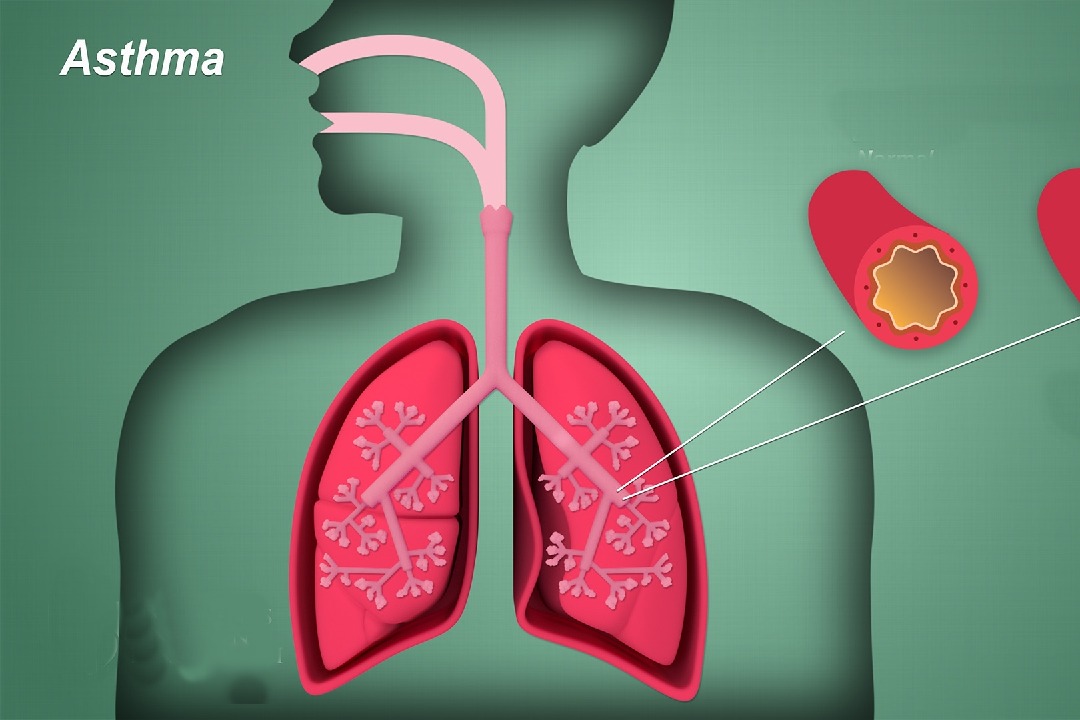 Food allergy in infancy may cause asthma & poor lung function later