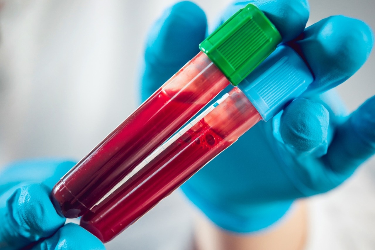 New blood test can spot Alzheimer's risk 15 yrs before symptoms appear