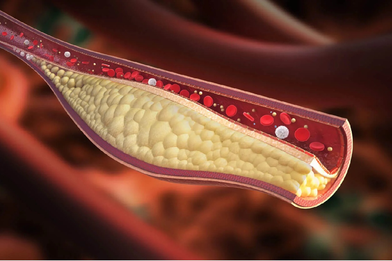 Sclerostin key protein for cardiovascular health in patients with
 diabetes: Study