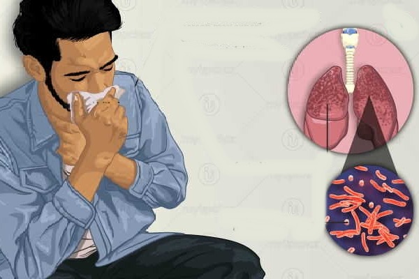 TB diagnosis must go beyond persistent cough: Lancet study