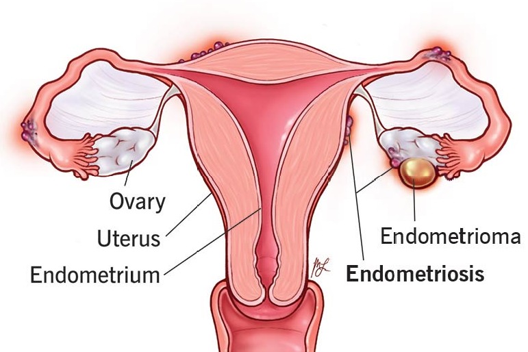 Swiss researchers develop a hydrogel implant to treat endometriosis