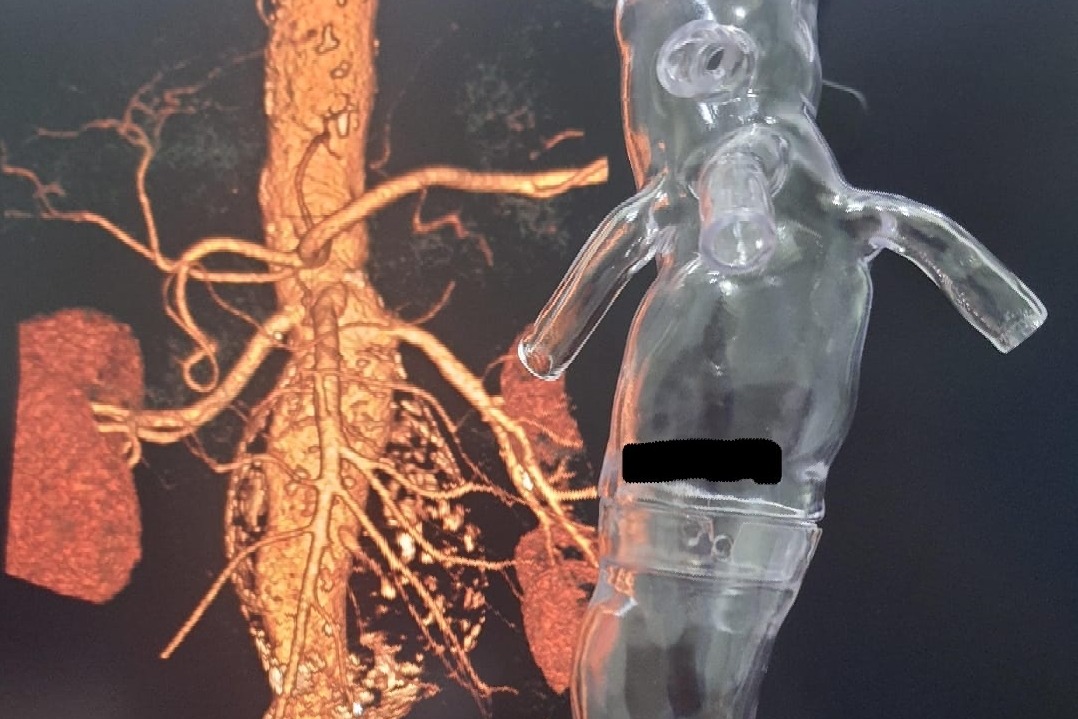 Bengaluru doctors treat Iraqi patient with 11cm large abdominal aneurysm