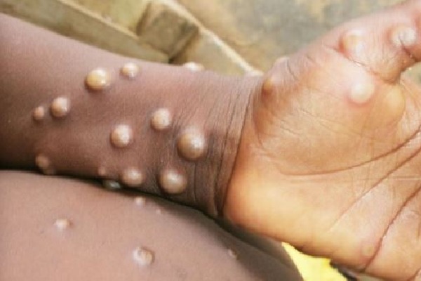 No reported case of Mpox in India, PM continuously monitoring situation: Centre