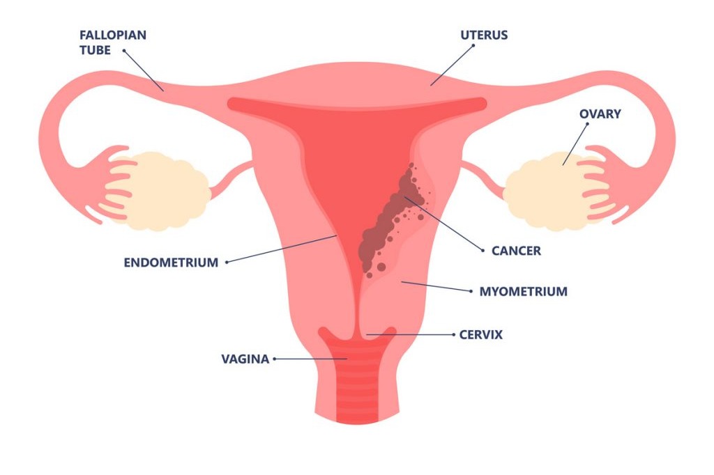 Why gynaecological cancers are rising among young Indian women