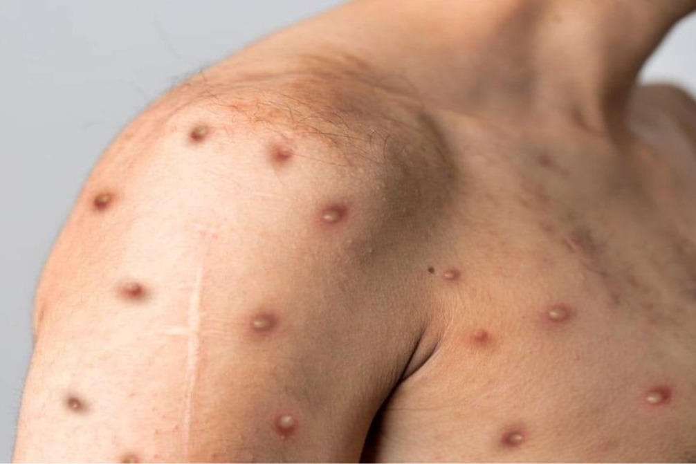 US confirms first case of clade I mpox in California