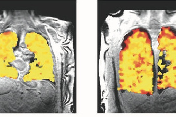 Scientists develop scan that unravels secrets of lung function