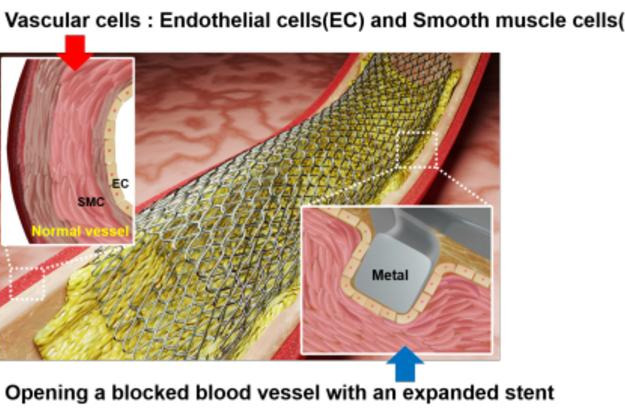 New laser patterning tech to revolutionise stent surgery for heart diseases