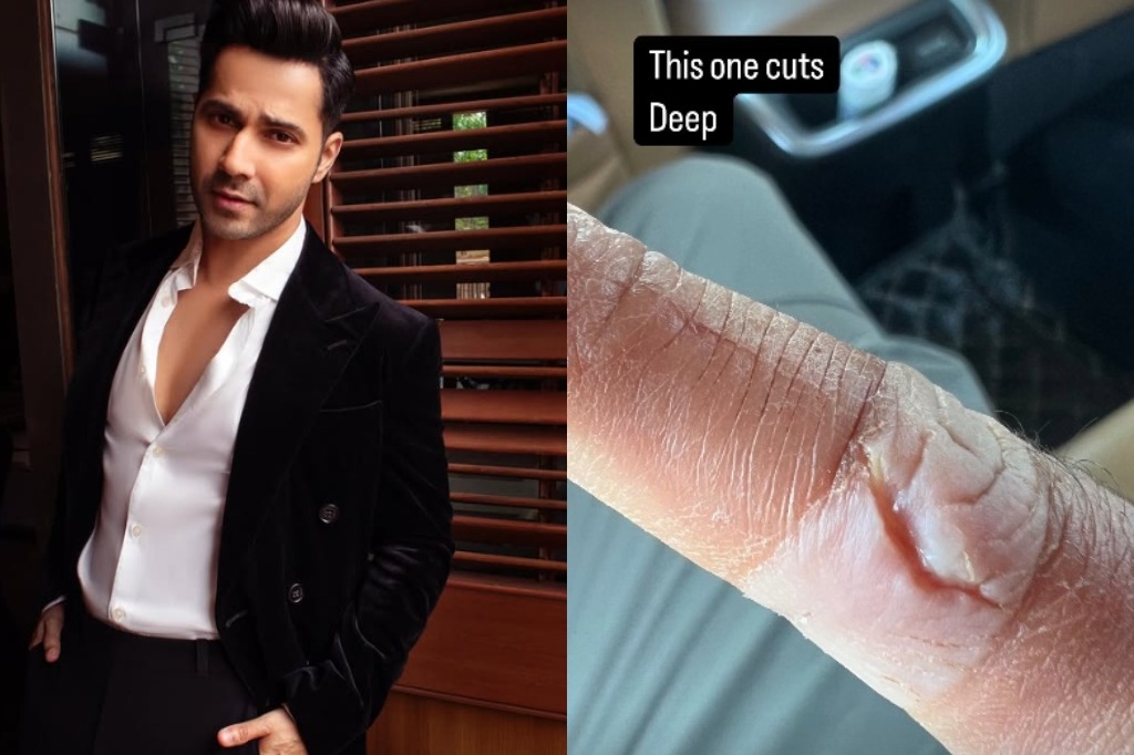 Varun Dhawan suffers injury, shows off deep cut on his finger