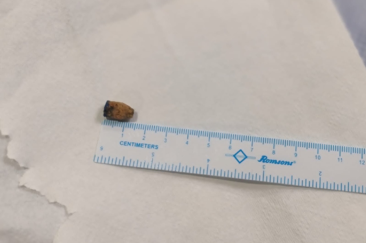 Hyderabad doctors remove pen cap stuck in man’s lungs for 21 years