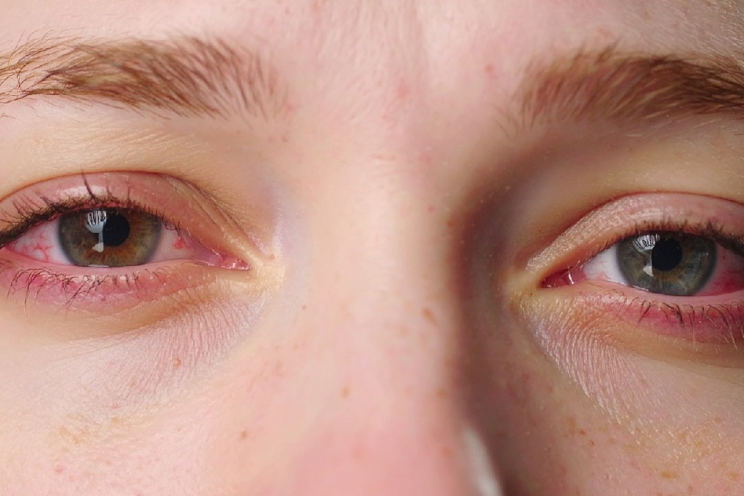 Just 1 hour of social media reels on smartphones can cause eye fatigue: Study