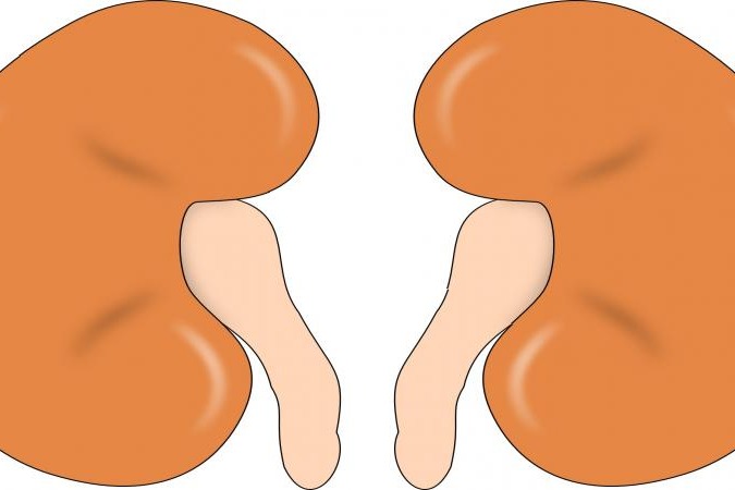 Madras HC quashes denial of kidney transplant over 'proof of friendship'