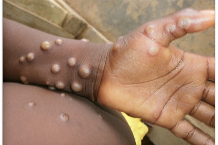 Mpox cases in Africa surpass 190,000, deaths near 2,000: Africa CDC