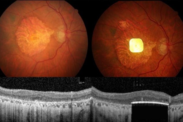 New retinal implant restores vision in patients with irreversible blindness