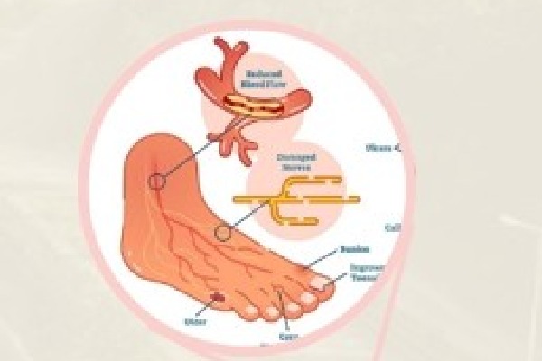 Nagaland University researchers find plant compound to treat diabetic wound, foot ulcers