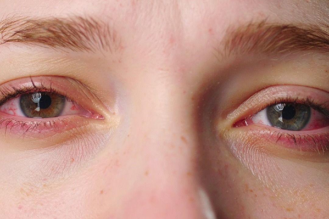 City doctors report 50 pc rise in eye problems as smog continues to engulf Delhi