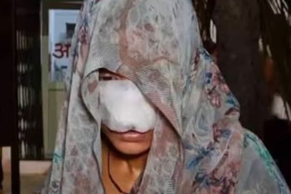 భార్యతో గొడవ.. ముక్కు, చెంపలు కొరికేసిన కిరాతక భర్త