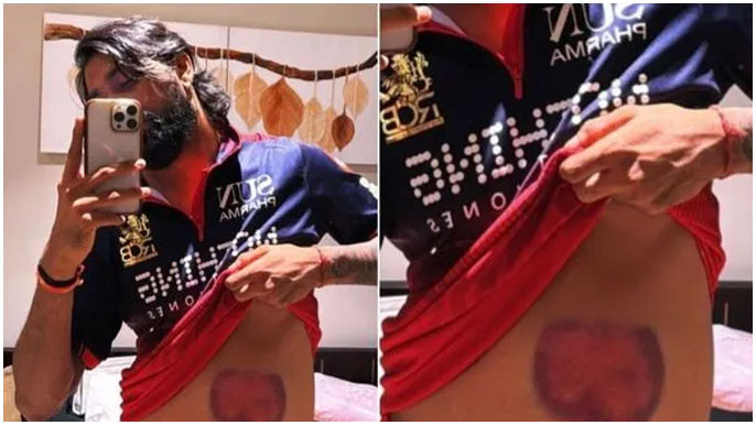 Krunal Pandya Shows Injuries After Match Winning Innings