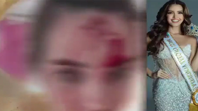 Miss Venezuela 2025 Shares Video Showing Injuries After Alleged Assault By Celebrity Stylist