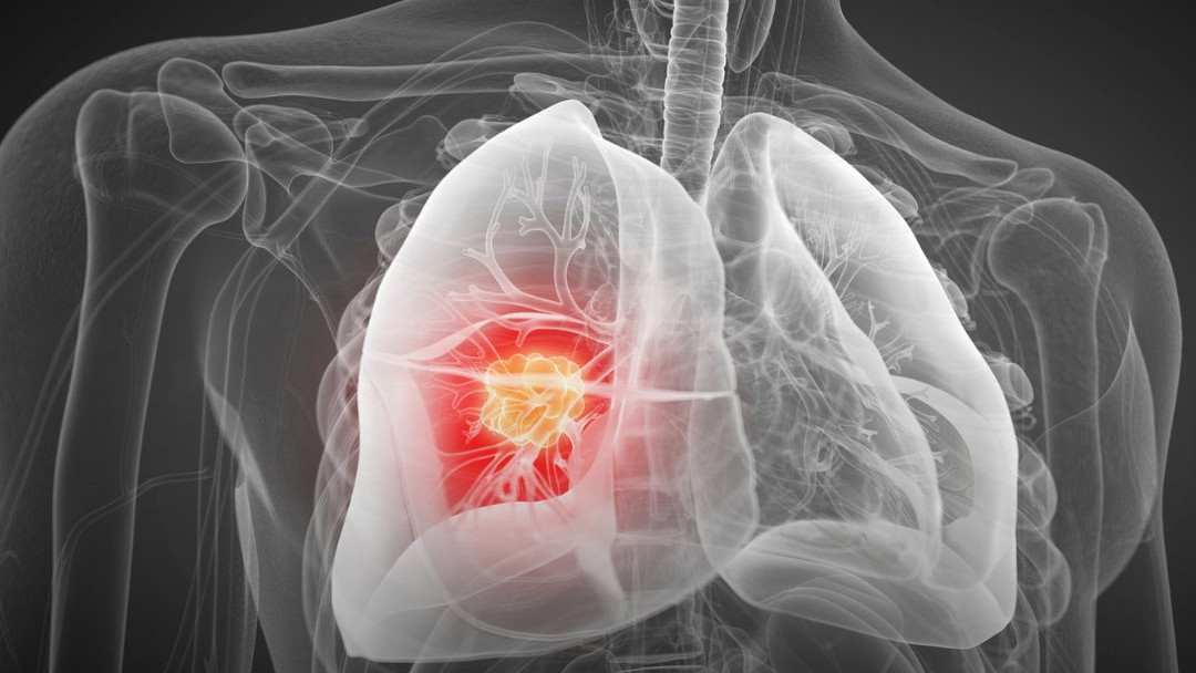 Lung cancer can be detected five years early with a drop of blood