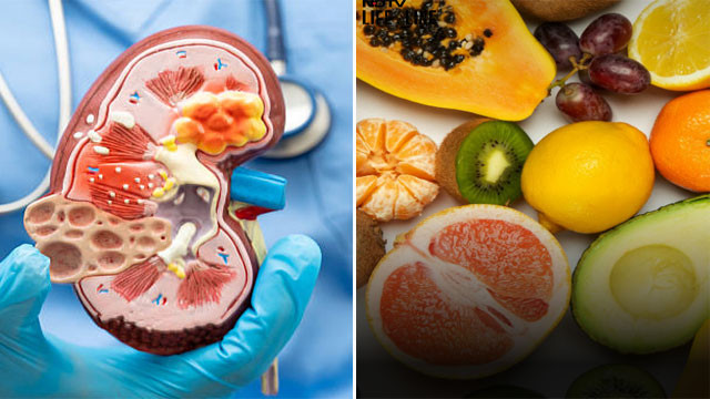 Kidney stone problem Include these fruits in your diet