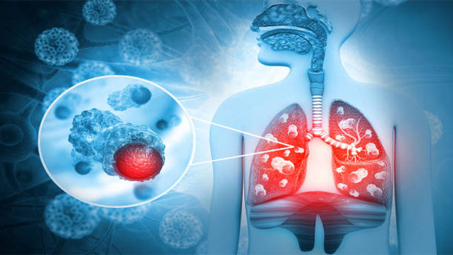 Lung cancer even without smoking Are you making these mistakes at home
