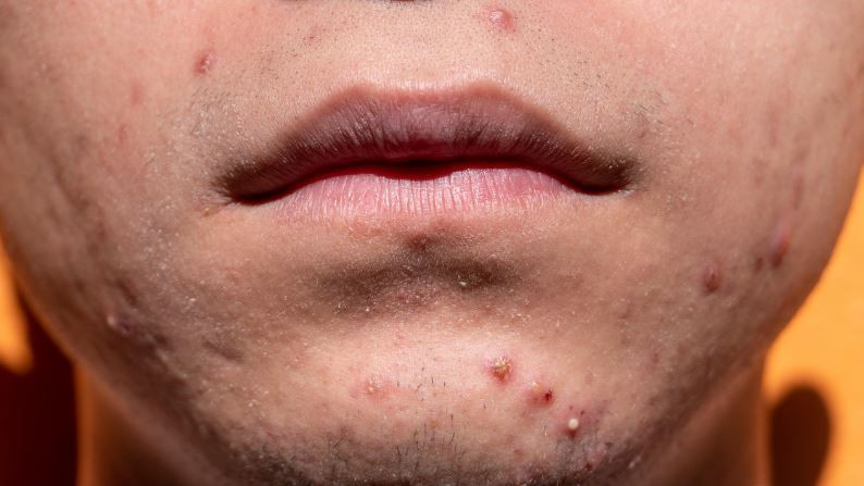 Acne treatment through healthy eating habits and nutrition