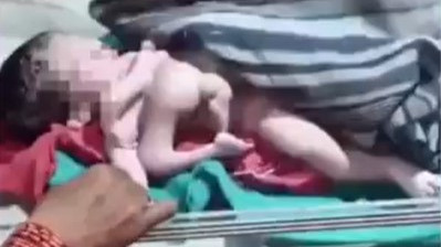 Rare incident in Madhya Pradesh baby born with 4 legs and 4 arms