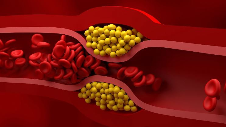 Bad cholesterol reduced by 52 percent with a single dose hopes for new gene therapy