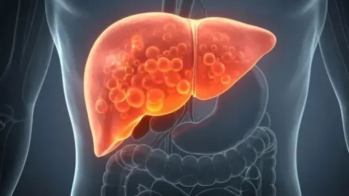 Fatty Liver problems without symptoms how to identify and treat early