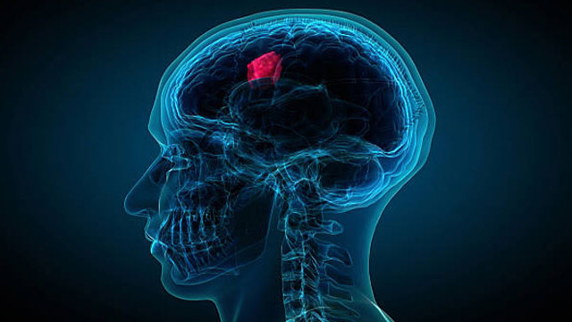 Brain tumor diagnosis game-changer test results in 2 hours instead of 8 weeks