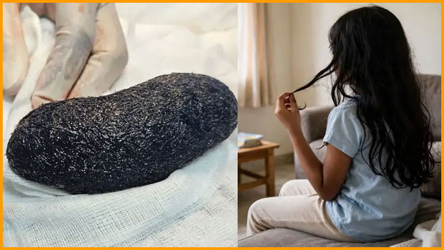 Rapunzel Syndrome Girl eats her own hair and doctors remove 1kg hairball from stomach