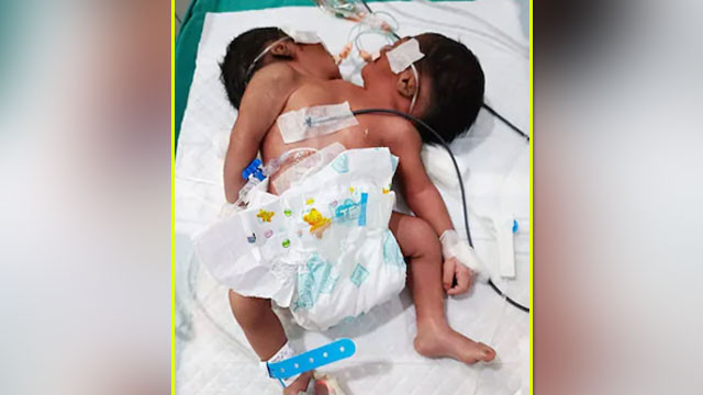 Two headed baby born in Odisha a rare medical case