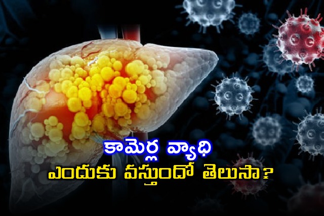 Jaundice Causes Symptoms and Prevention Tips