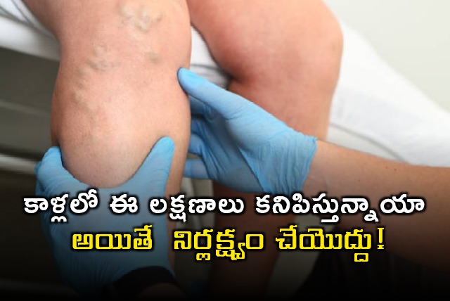 Varicose Veins Symptoms You Shouldnt Ignore in Your Legs