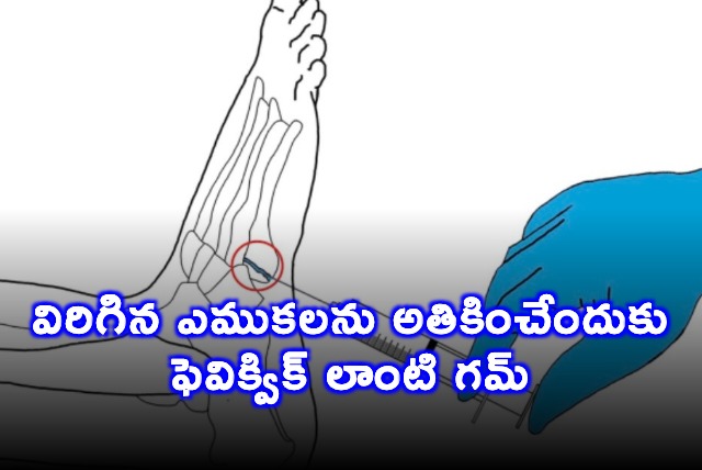 Lin Shanfeng Chinese Researchers Invent Bone Mending Glue