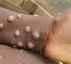 CDC and Texas Confirm Monkeypox In US
