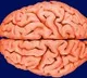 Woman recites Hanuman Chalisa while critical brain surgery at AIIMS