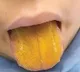 Boy Tongue Changed To Yellow Suffered Auto Immune Disorder