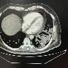 Doctors at SLG Hospitals remove “Black & White Fungus” ball from Lungs