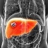 Liver abscesses most common in India -- and Covid-19 has pushed up the numbers