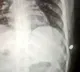 Man thought a cat scratched him but in reality a bullet lodged in his ribs