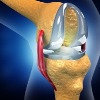 Indian scientists develop models to help improve hip, knee implants