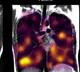 Lungs In Long Covid Patients Suffering Damage