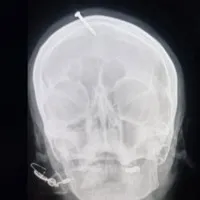 Fake baba drills nail into pregnant lady head to give birth to a baby boy